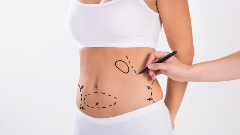 Liposuction ile Bölgesel İncelme